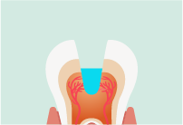 削った歯にフッ化物合材を詰めて歯髄を保護・修復象牙質の形成を促した状態を表したイラスト