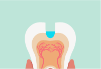 削った歯にフッ化物合材を詰めて歯髄を保護・修復象牙質の形成を促した状態を表したイラスト